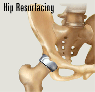 Hip Resurfacing